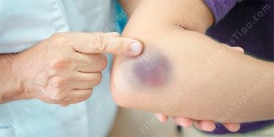 filmes sobre ematoma