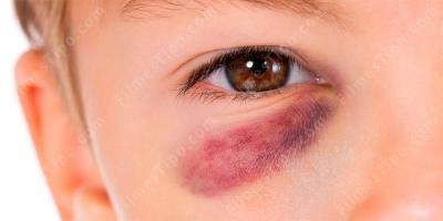 filmes sobre olho roxo